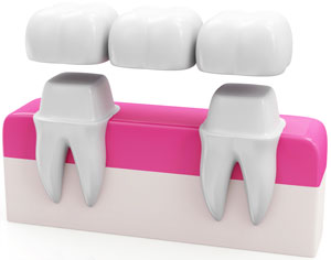 What does a Dental Bridge look like?